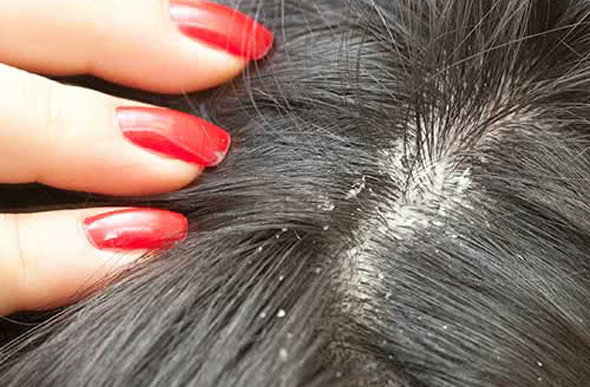 Descamação do couro cabeludo pode ser evitado tomando alguns cuidados / Foto Ilustrativa: saudemedicina.com 