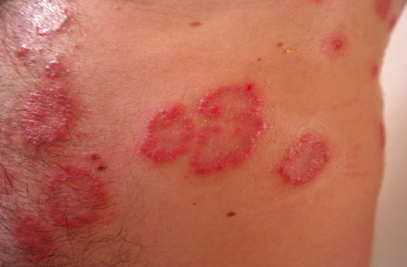 Psoríase é uma doença crônica da pele, não contagiosa, caracterizadas por placas avermelhadas ou róseas — Foto: Pixabay/Divulgação