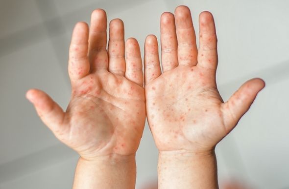 Doença mão-pé-boca é altamente contagiosa e geralmente acomete crianças com menos de 5 anos. Foto: Kipgodi/GI/Getty Images   Leia mais em: https://saude.abril.com.br/familia/doenca-mao-pe-boca/