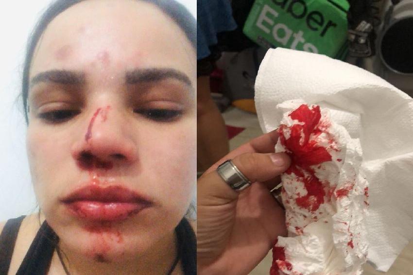 Vítima de 29 anos quebrou o nariz com a agressão./ Foto: Reprodução
