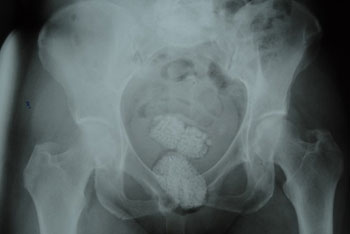 Sacolas com diamantes identificada em radiografia