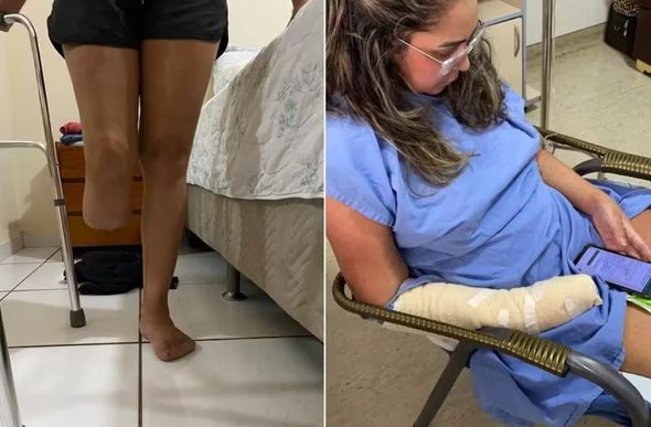 Consequências de lipoaspiração causaram amputação de membro inferior e dedos de mulher em Goiânia — Foto: Arquivo Pessoal