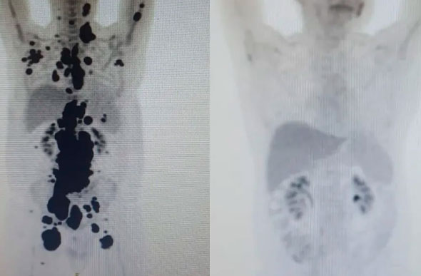Exames mostram antes e depois de câncer de paciente; à direita, imagem mostra remissão da doença — Foto: Arquivo pessoal